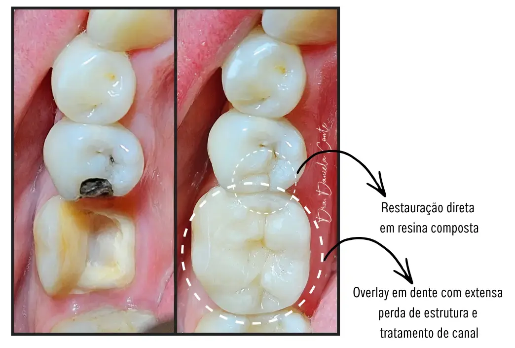 Tratamento para dente quebrado