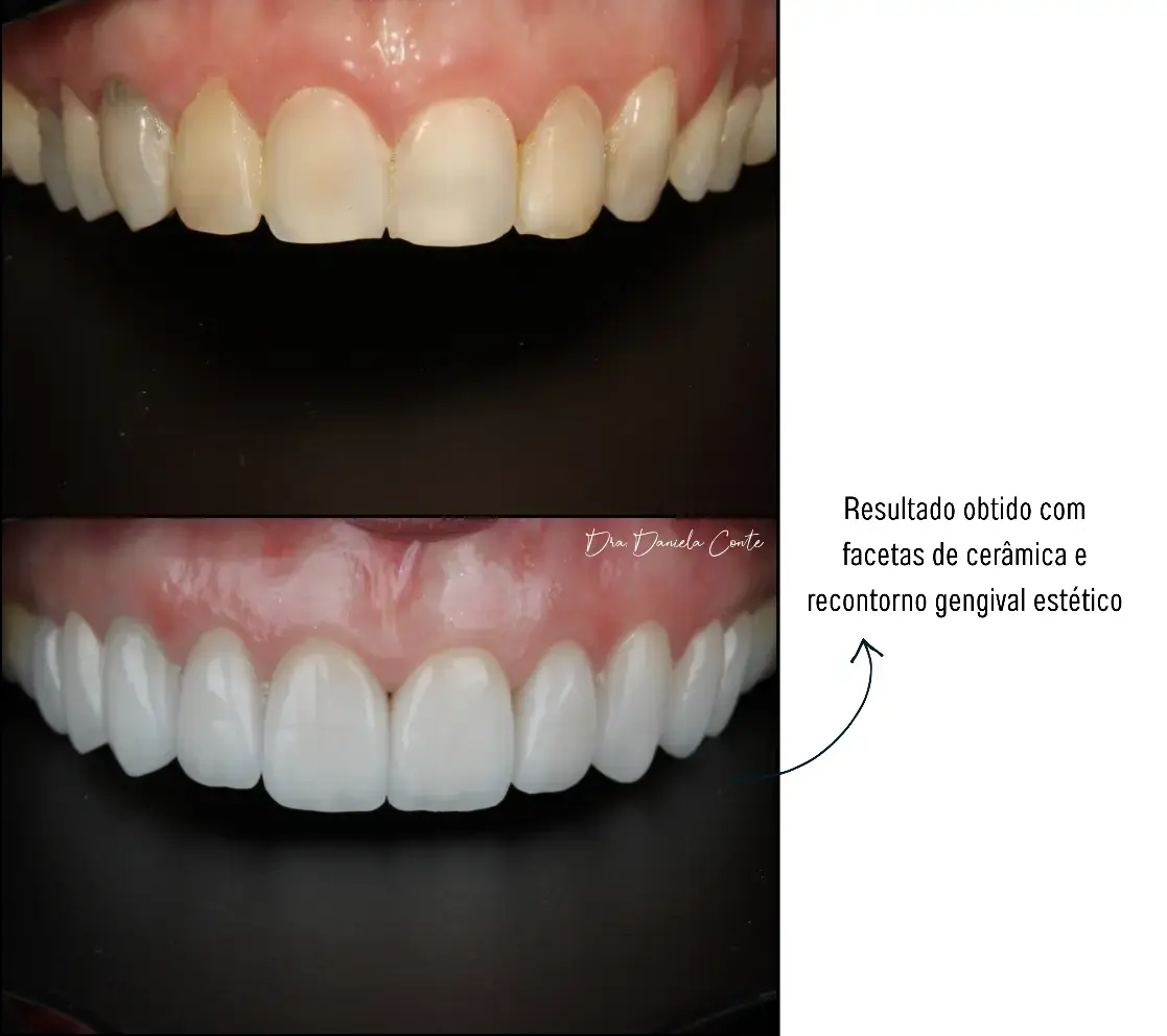Resultado antes e depois: Facetas Cerâmicas