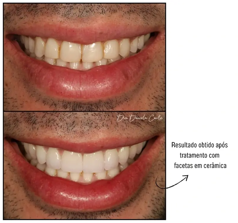 Resultado antes e depois: Facetas cerâmicas